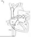 Fig. 01 - BIPOLAR TISSUE VAPORIZATION DEVICE WITH NON-VAPORIZING SURFACE