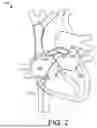 Fig. 03 - BIPOLAR TISSUE VAPORIZATION DEVICE WITH NON-VAPORIZING SURFACE