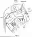Fig. 63 - Catheter with a Double Balloon Structure to Generate and Apply a Heated Ablative Zone to Tissue