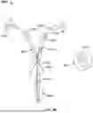 Fig. 83 - Catheter with a Double Balloon Structure to Generate and Apply a Heated Ablative Zone to Tissue