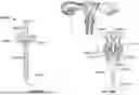 Fig. 87 - Catheter with a Double Balloon Structure to Generate and Apply a Heated Ablative Zone to Tissue