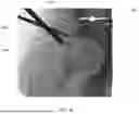 Fig. 33 - SYSTEMS AND METHODS FOR VISUALLY GUIDING BONE REMOVAL DURING A SURGICAL PROCEDURE ON A JOINT