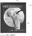 Fig. 43 - SYSTEMS AND METHODS FOR VISUALLY GUIDING BONE REMOVAL DURING A SURGICAL PROCEDURE ON A JOINT