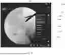 Fig. 44 - SYSTEMS AND METHODS FOR VISUALLY GUIDING BONE REMOVAL DURING A SURGICAL PROCEDURE ON A JOINT