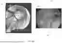 Fig. 49 - SYSTEMS AND METHODS FOR VISUALLY GUIDING BONE REMOVAL DURING A SURGICAL PROCEDURE ON A JOINT
