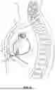 Fig. 04 - THORACIC ACCESS TUNNELING TOOL WITH LIGHT EMITTER FOR VISIBILITY