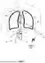 Fig. 06 - THORACIC ACCESS TUNNELING TOOL WITH LIGHT EMITTER FOR VISIBILITY