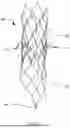 Fig. 06 - CAPTURING FLOWING DEBRIS IN THE VENA CAVA