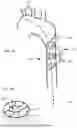Fig. 09 - CAPTURING FLOWING DEBRIS IN THE VENA CAVA