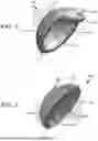 Fig. 02 - DERMAL CAP FOR RESURFACING BONE JOINTS