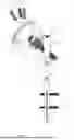 Fig. 02 - BONE PRESERVING ANATOMIC HIP ARTHROPLASTY SYSTEM