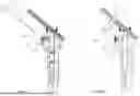 Fig. 22 - BONE PRESERVING ANATOMIC HIP ARTHROPLASTY SYSTEM