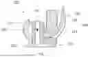 Fig. 02 - Total Stabilizing Knee Joint Prosthesis