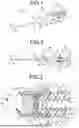 Fig. 02 - Valved Needle Assembly and Indwelling Needle Assembly