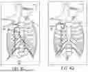 Fig. 09 - OBSTRUCTIVE SLEEP APNEA TREATMENT DEVICES, SYSTEMS AND METHODS