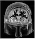 Fig. 01 - TARGETED NEUROMODULATION TO IMPROVE NEUROPSYCHIATRIC FUNCTION