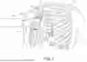 Fig. 02 - ATRIAL SYNCHRONIZED VENTRICULAR PACING SYSTEM