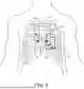 Fig. 03 - ATRIAL SYNCHRONIZED VENTRICULAR PACING SYSTEM