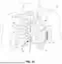 Fig. 02 - PREVENTING CAPACITOR REVERSE BIASING DURING DISCHARGE IN MEDICAL DEVICE