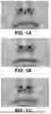 Fig. 02 - SYSTEMS FOR UPPER LIP LIFT PROCEDURES AND METHODS OF THEIR USE
