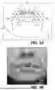 Fig. 09 - SYSTEMS FOR UPPER LIP LIFT PROCEDURES AND METHODS OF THEIR USE