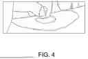 Fig. 05 - EPIDERMIS ANCHORING SYSTEM FOR DELIVERY TOOL