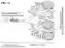 Fig. 03 - METHOD OF REDUCING MICROVASCULAR OBSTRUCTIONS BY PROVIDING VENTRICULAR SUPPORT