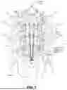 Fig. 10 - METHODS AND SYSTEMS FOR IMPLANTING A NEUROMODULATION SYSTEM AT A SURGICALLY OPEN SPINAL TREATMENT SITE