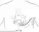 Fig. 07 - PERICARDIAL LEAD