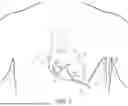 Fig. 09 - PERICARDIAL LEAD