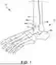 Fig. 02 - SYSTEMS AND METHODS FOR INSTALLING AN ORTHOPEDIC IMPLANT
