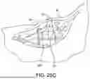 Fig. 22 - SYSTEMS AND METHODS FOR INSTALLING AN ORTHOPEDIC IMPLANT