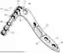Fig. 01 - LATERAL PROXIMAL TIBIA PLATE WITH EXTENSION ARM