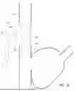 Fig. 51 - SYSTEMS AND METHODS FOR SELECTIVELY OCCLUDING THE SUPERIOR VENA CAVA FOR TREATING HEART CONDITIONS