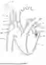 Fig. 68 - SYSTEMS AND METHODS FOR SELECTIVELY OCCLUDING THE SUPERIOR VENA CAVA FOR TREATING HEART CONDITIONS