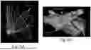 Fig. 07 - LEFT ATRIAL APPENDAGE CLOSURE DEVICE SPECIFICATION FROM 2D ICE TO TREAT ATRIAL FIBRILLATION PATIENTS