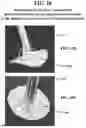 Fig. 33 - DEVICES AND METHODS FOR REPAIRING AND SEALING TISSUE FENESTRATIONS DURING OPEN AND MINIMALLY INVASIVE SURGICAL PROCEDURES
