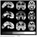 Fig. 09 - METHODS AND SYSTEMS FOR RESTING STATE FMRI BRAIN MAPPING WITH REDUCED IMAGING TIME