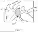 Fig. 03 - SUTURE/ANCHOR AND DELIVERY DEVICE COMBINATION