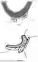 Fig. 02 - TIBIAL AUGMENT BLOCK
