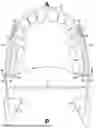 Fig. 01 - BILATERAL TONGUE BASE REPOSITIONER