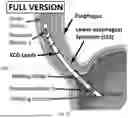Fig. 43 - Multifunction Newborn Gavage Tube