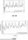 Fig. 05 - Methods and Systems for Lowering Blood Pressure Through Reduction of Ventricle Filling