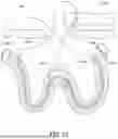 Fig. 52 - KNOTLESS SUTURE ANCHORS