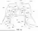 Fig. 63 - KNOTLESS SUTURE ANCHORS