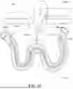 Fig. 65 - KNOTLESS SUTURE ANCHORS