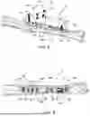Fig. 07 - BONE SHORTENING OSTEOTOMY APPARATUS