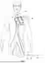 Fig. 02 - BALLOON CATHETERS FOR PROSTHETIC IMPLANTS