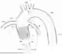 Fig. 01 - GUIDEWIRE FOR IMPROVED REPLACEMENT HEART VALVE DELIVERY