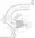 Fig. 02 - GUIDEWIRE FOR IMPROVED REPLACEMENT HEART VALVE DELIVERY